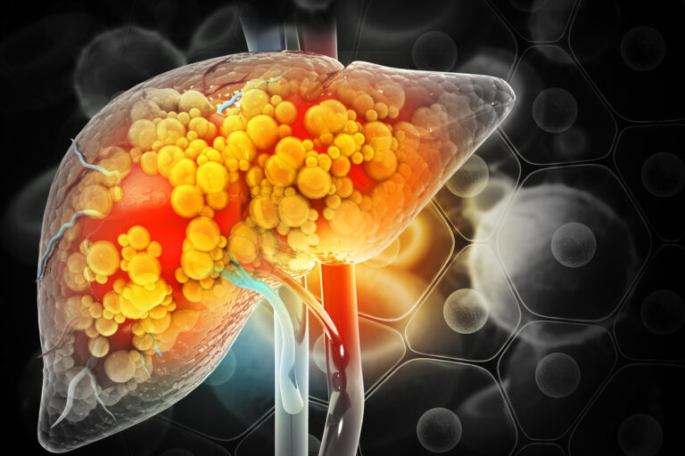 Fatty Liver Disease: Causes and Treatment Options - GI Associates