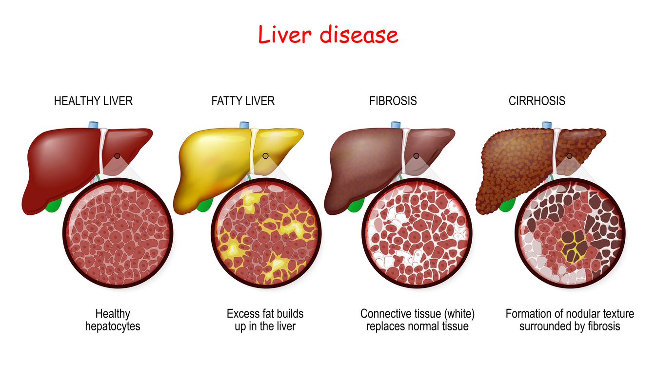 Liver diseases