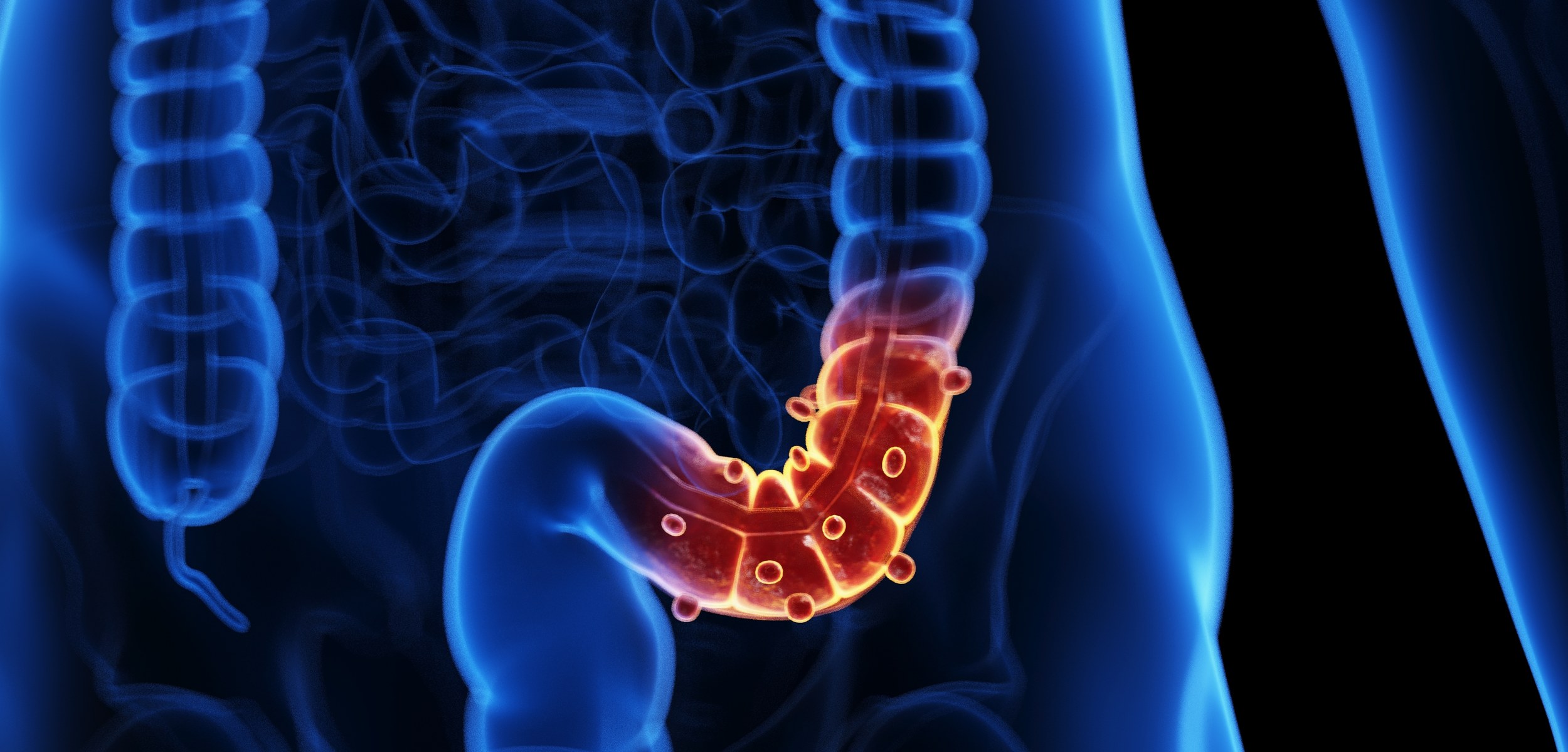 colon polyps - Colon Polyps