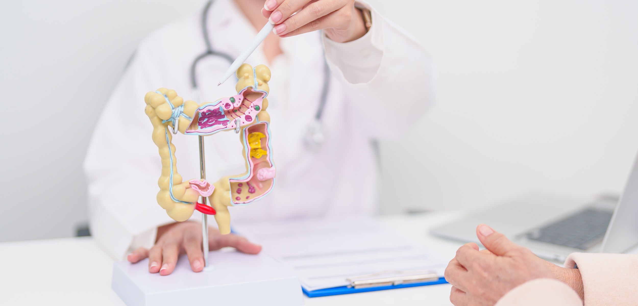 colon cancer - Colon Cancer Prevention